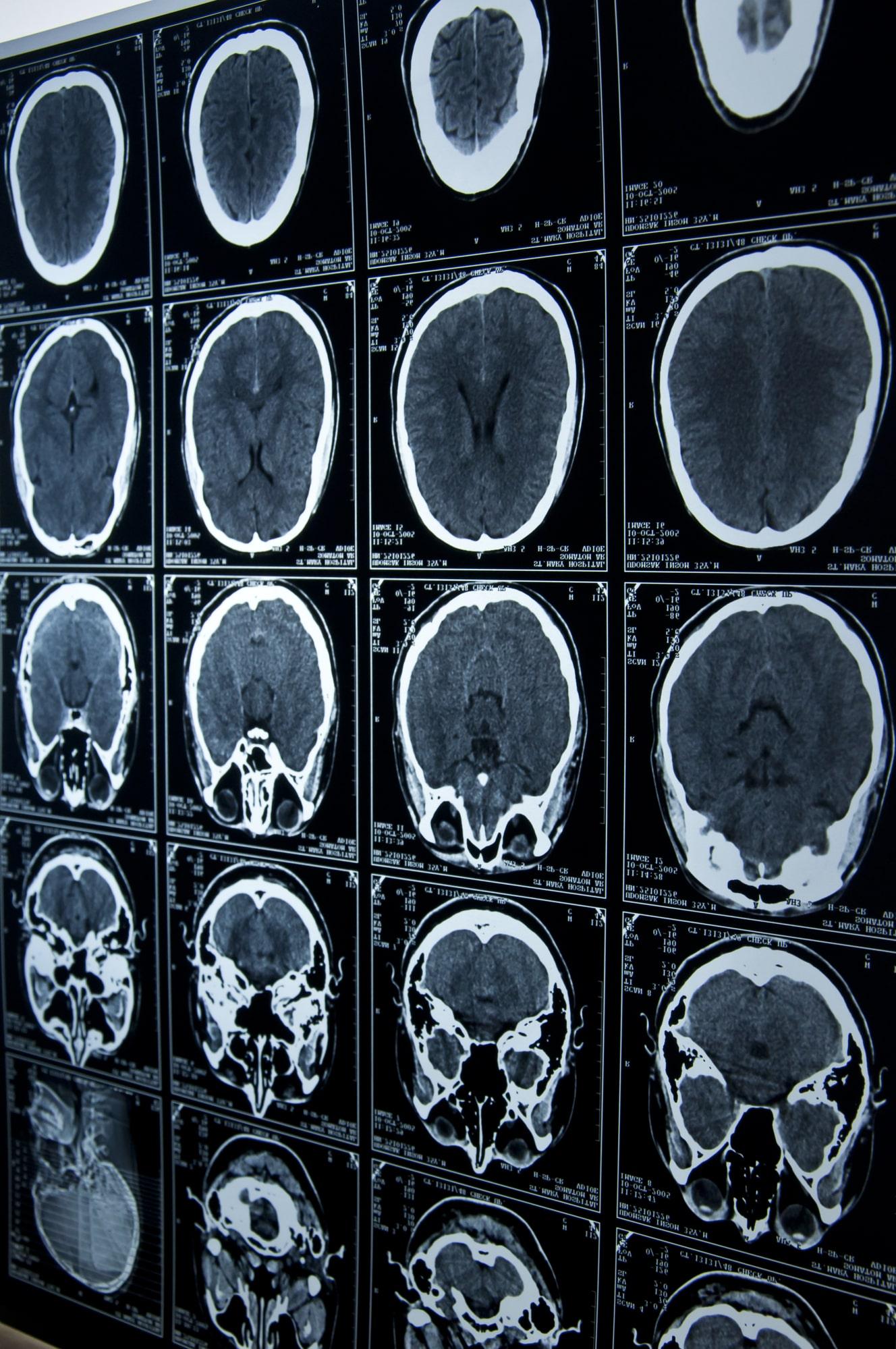 Brain injury scan